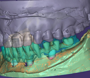 Planificación digital de arcada con implantes.