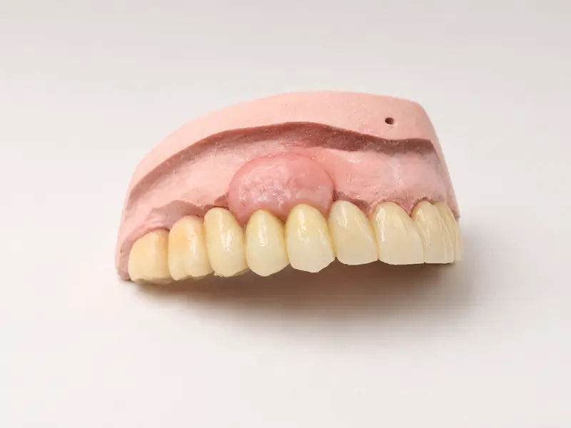 Reconstrucció sobre implants.