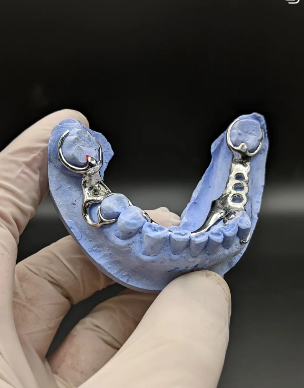 Prótesis removible metálica.